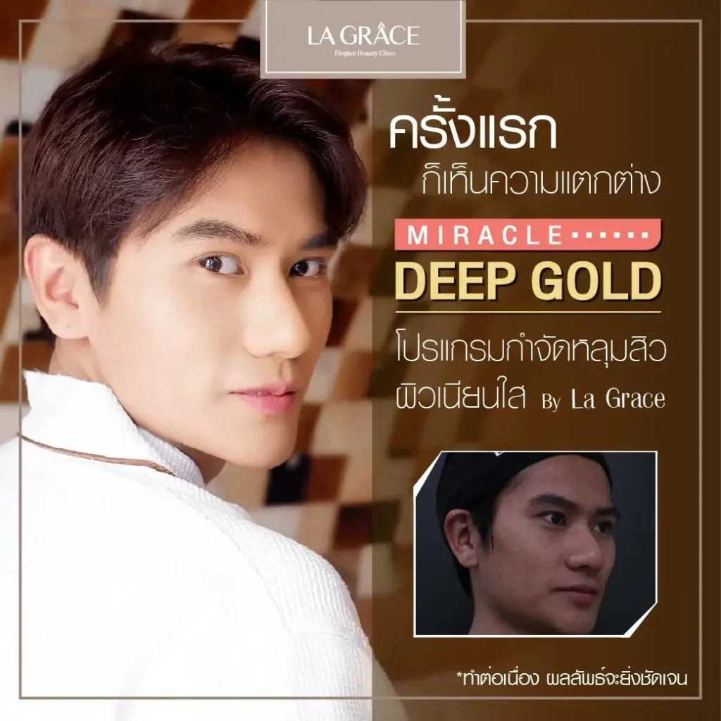 เทคนิคฟื้นฟูผิวหน้าเป็นหลุม