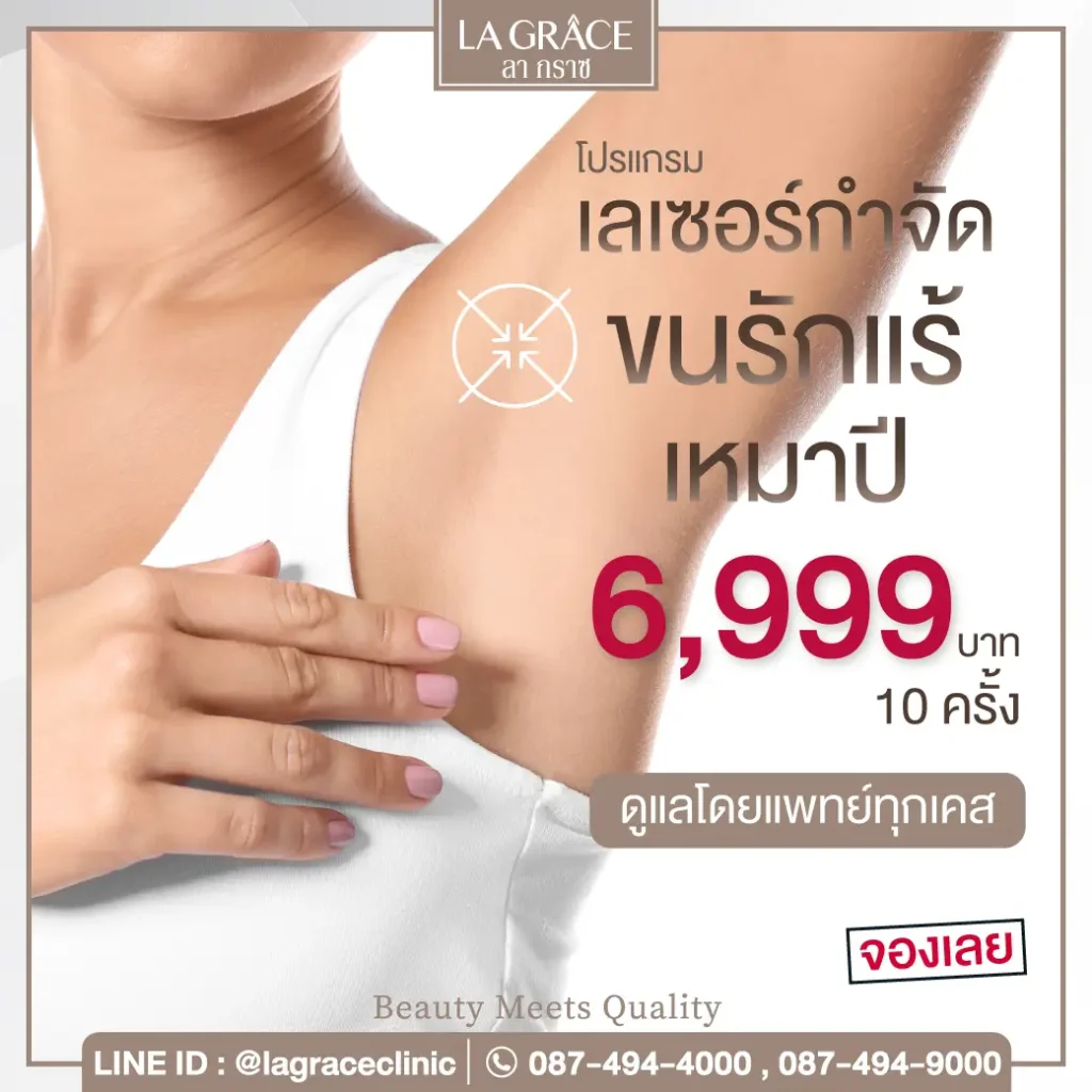 เลเซอร์กำจัดขน