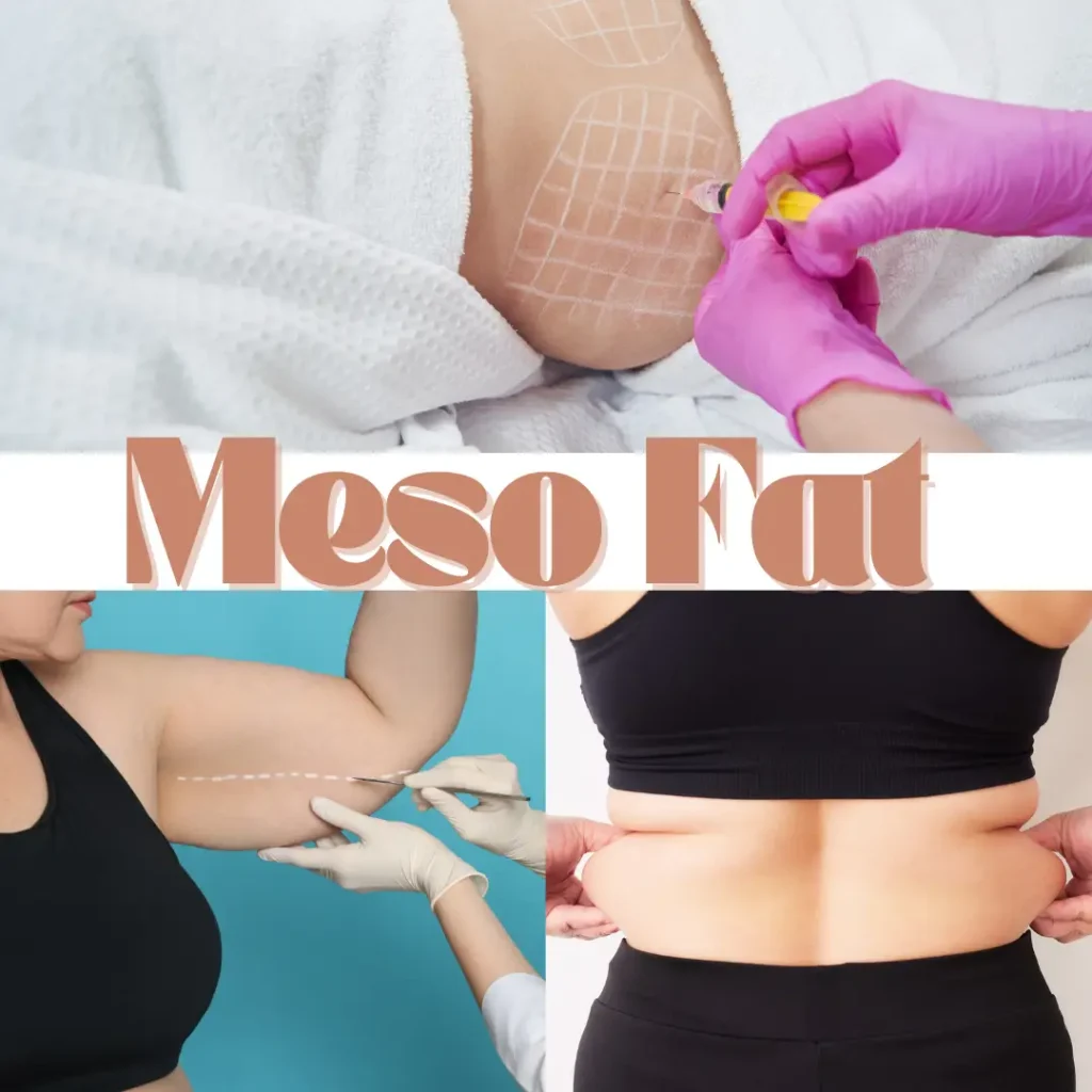 Meso Fat