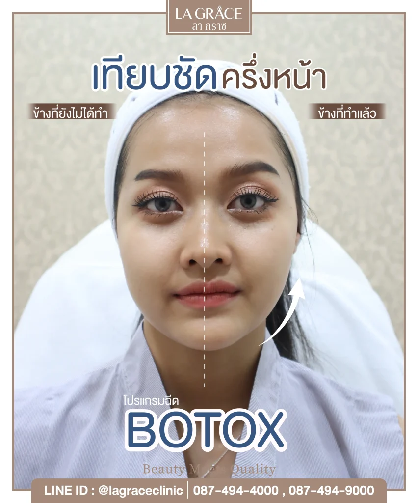ผลลัพธ์การ ฉีดโบท็อกซ์ ที่ La Grace Clinic เปรียบเทียบก่อนและหลังครึ่งหน้า