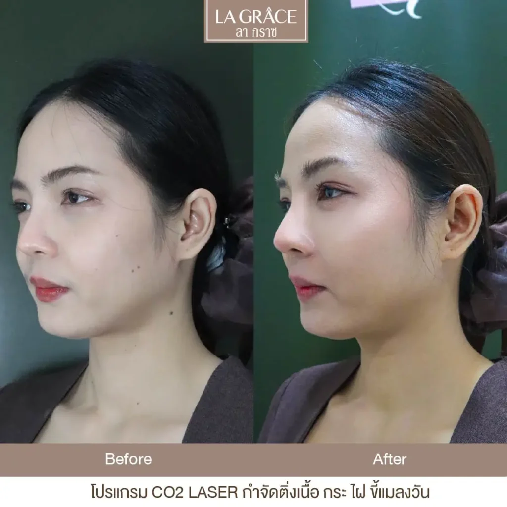 CO2 Laser รักษาไฝ ขี้แมลงวัน