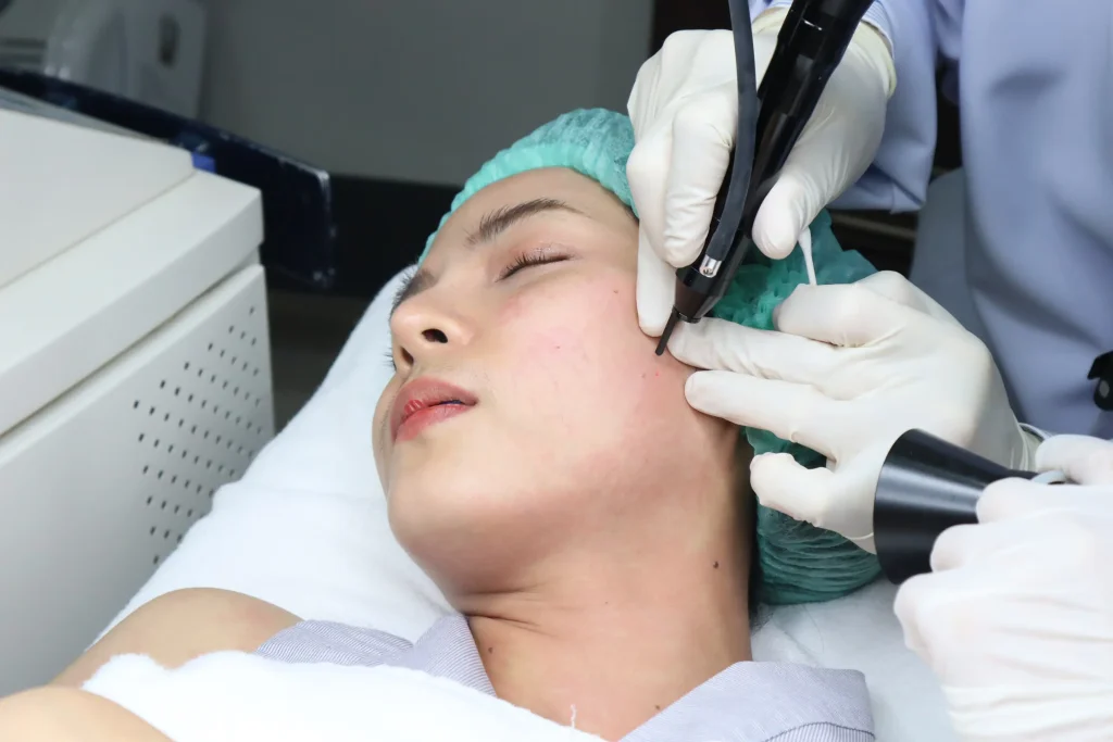 แพทย์กำลังใช้เครื่อง CO2 Laser เพื่อกำจัดไฝ และขี้แมลงวัน