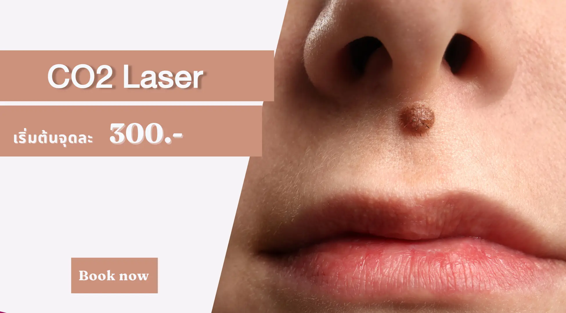 CO2 Laser