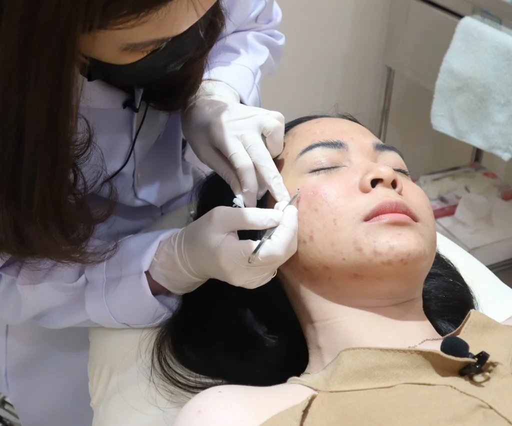 ขั้นตอนการทำโปรแกรม Acne Clear