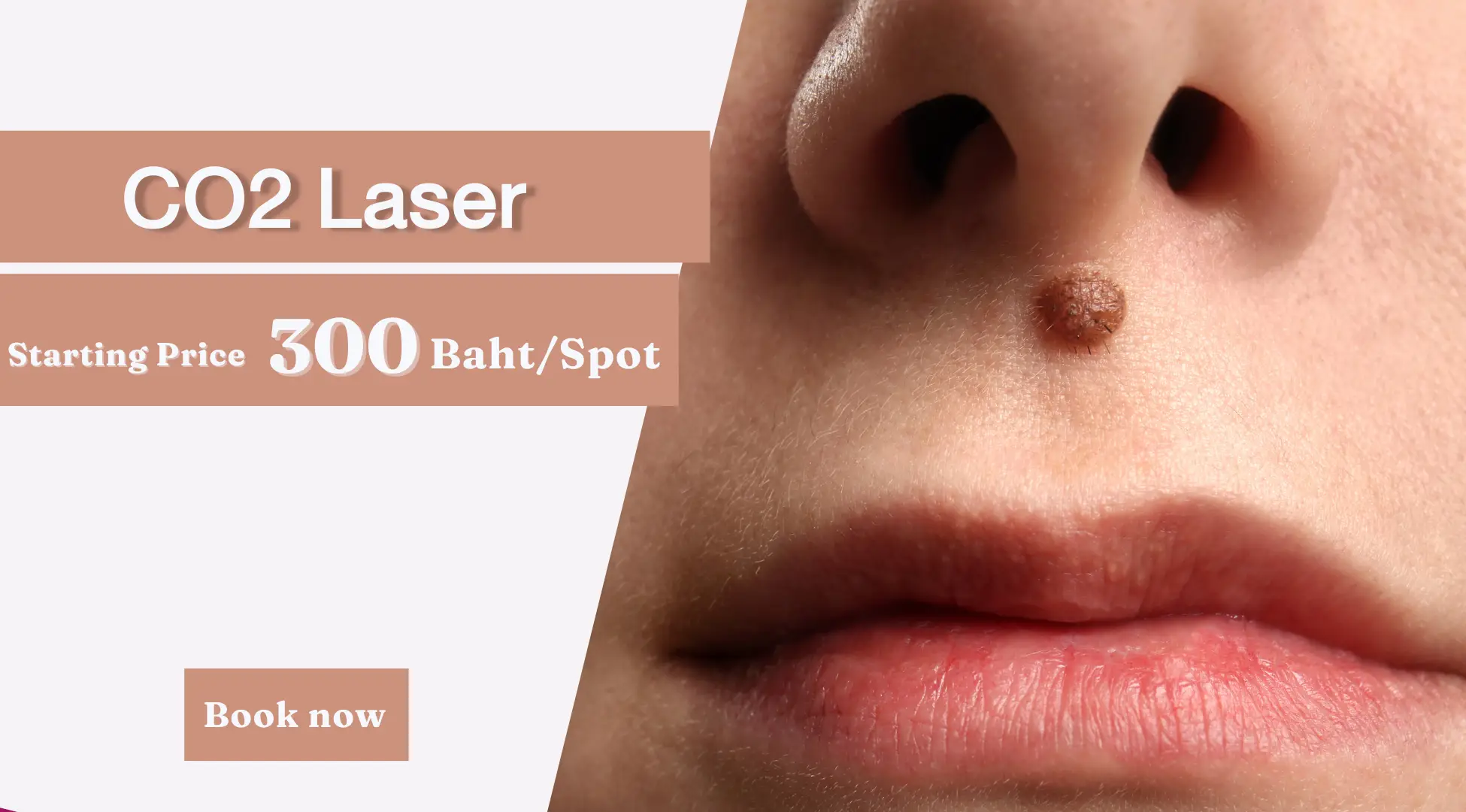 CO2 Laser