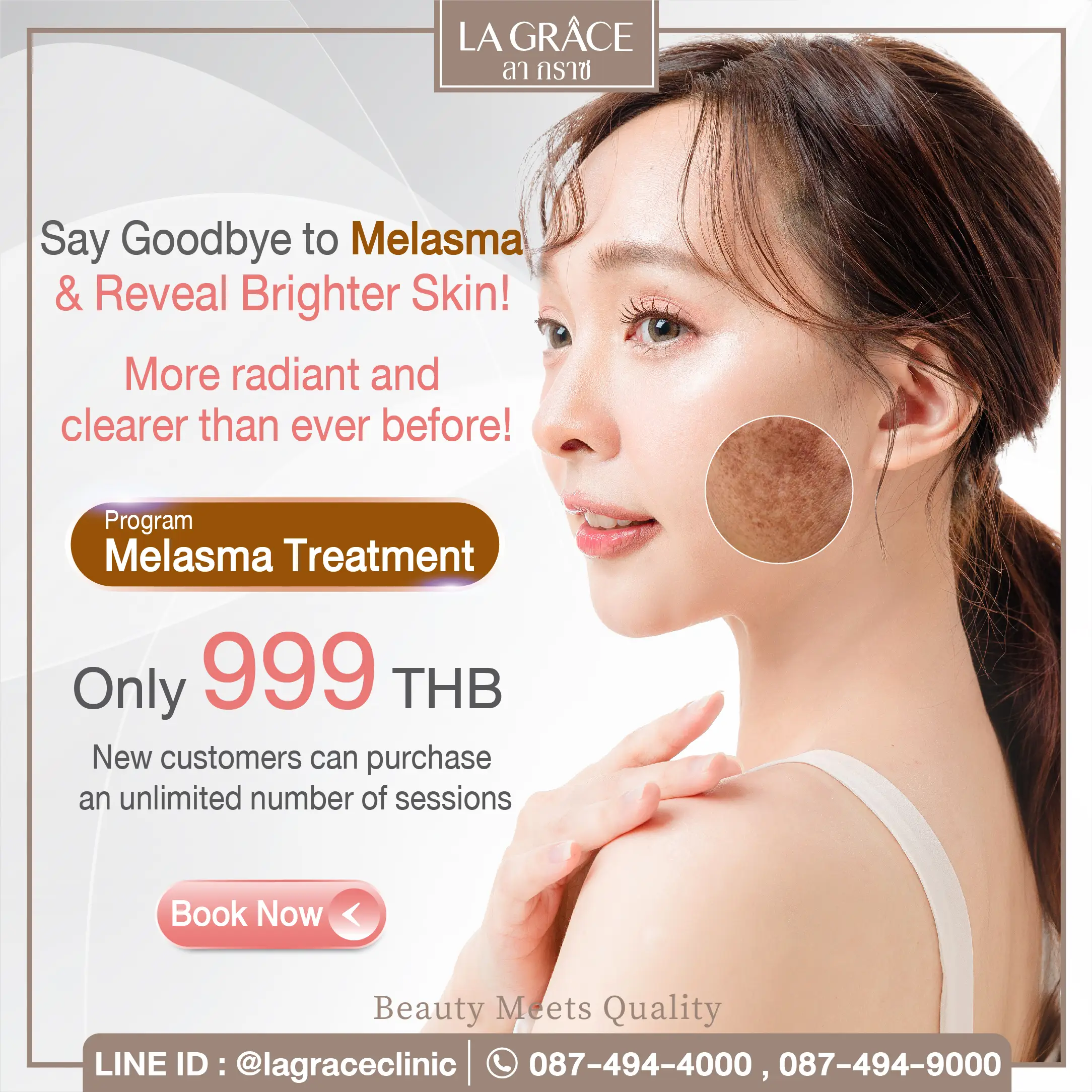 Melasma