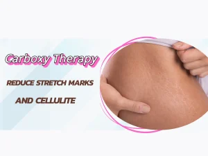 Carboxy Therapy