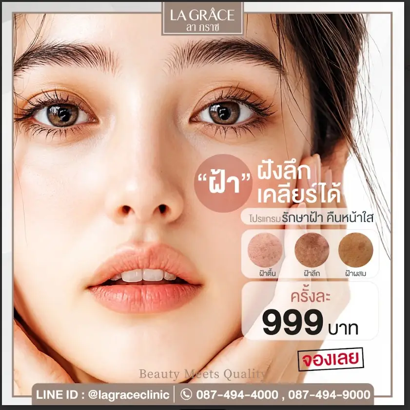 รักษาฝ้า