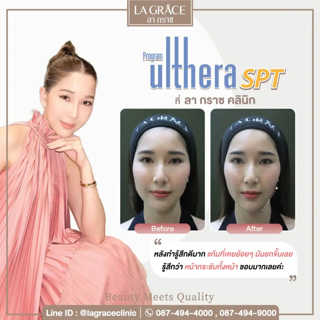 Ulthera ราคาเริ่มต้น 9,999 บาท