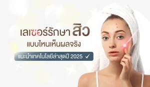 เลเซอร์รักษาสิว