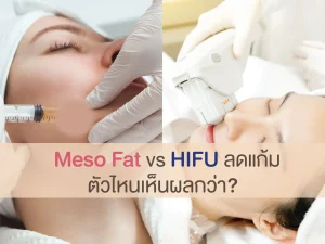 Meso Fat vs HIFU ลดแก้ม