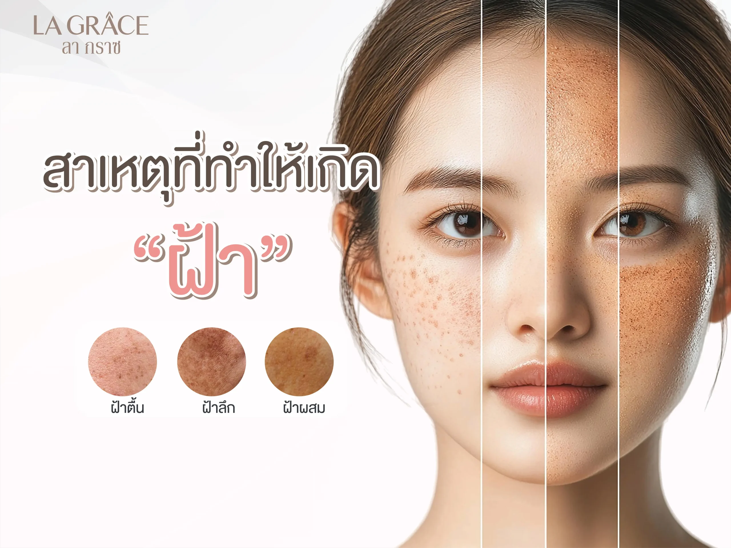 สาเหตุการเกิดฝ้า