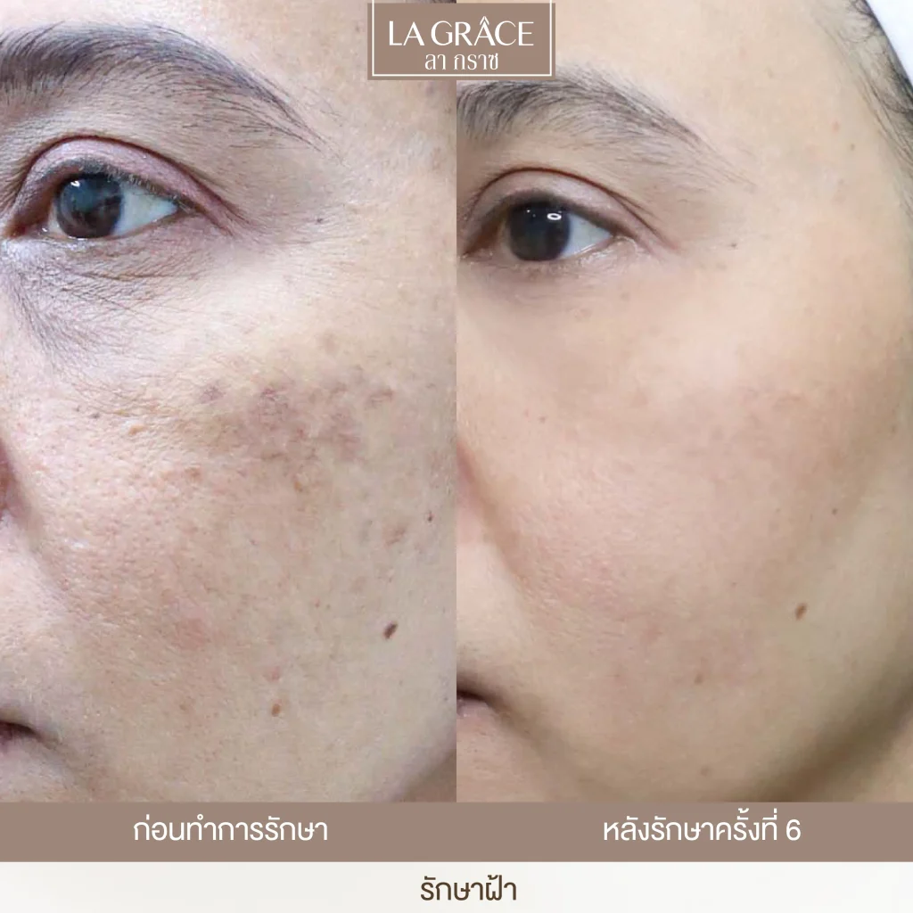 ก่อนหลังรักษาฝ้า melasma ผลลัพธ์หลัง 6 ครั้ง