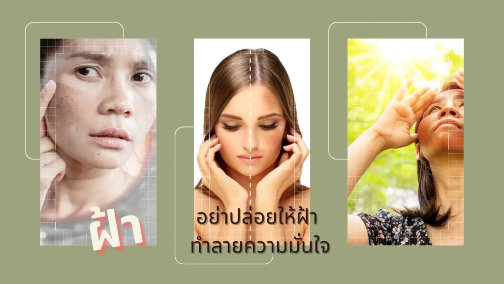 ป้องกันฝ้าไม่ให้กลับมา