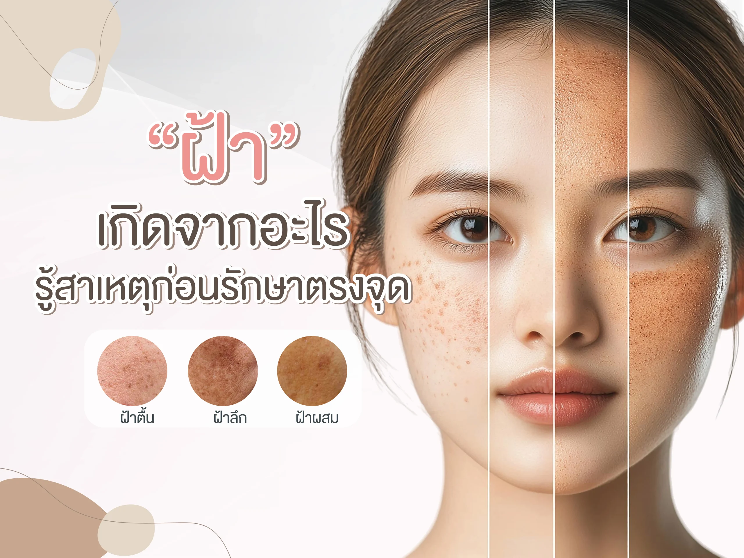 ฝ้าเกิดจากอะไร