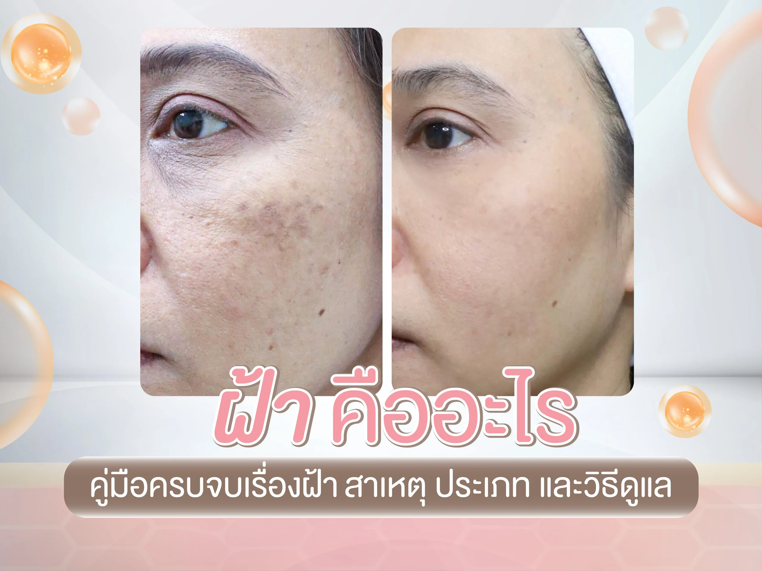ฝ้า คืออะไร