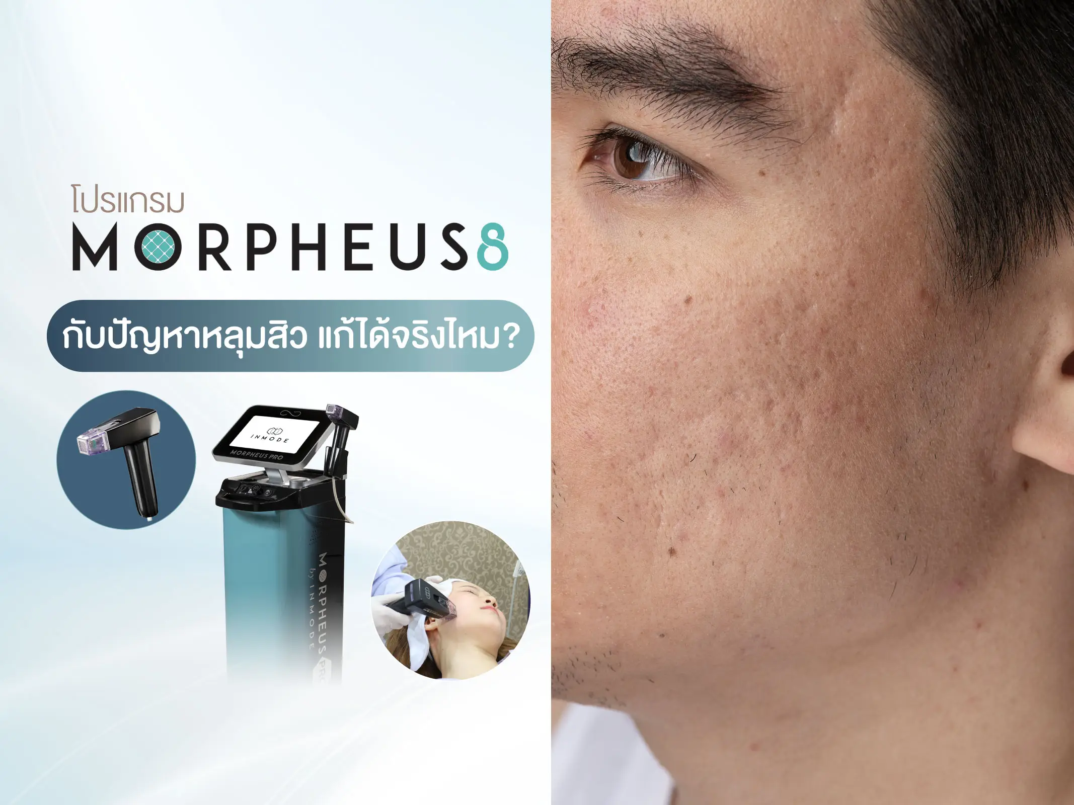 Morpheuse 8 หลุมสิว