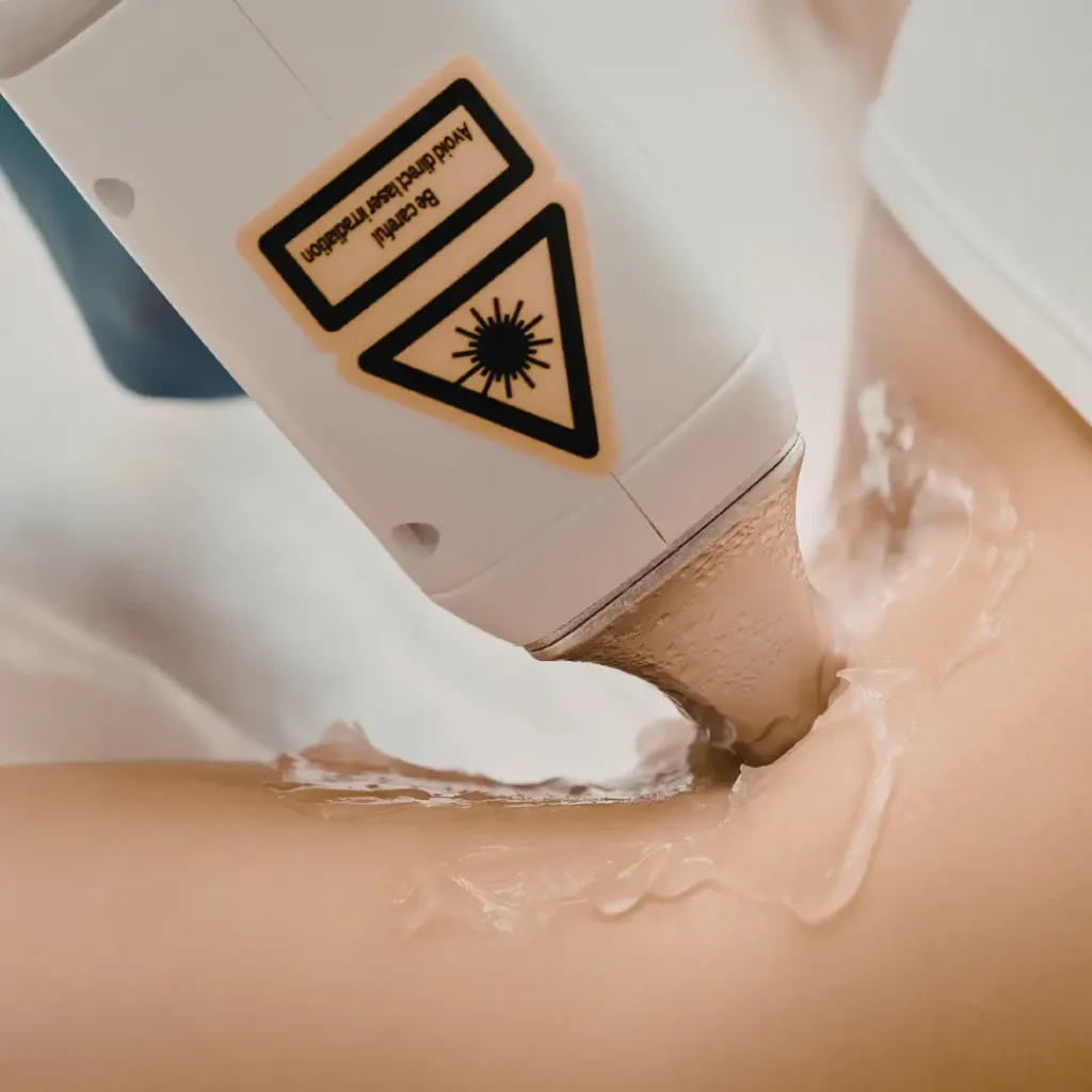 คู่มือเลเซอร์กำจัดขน