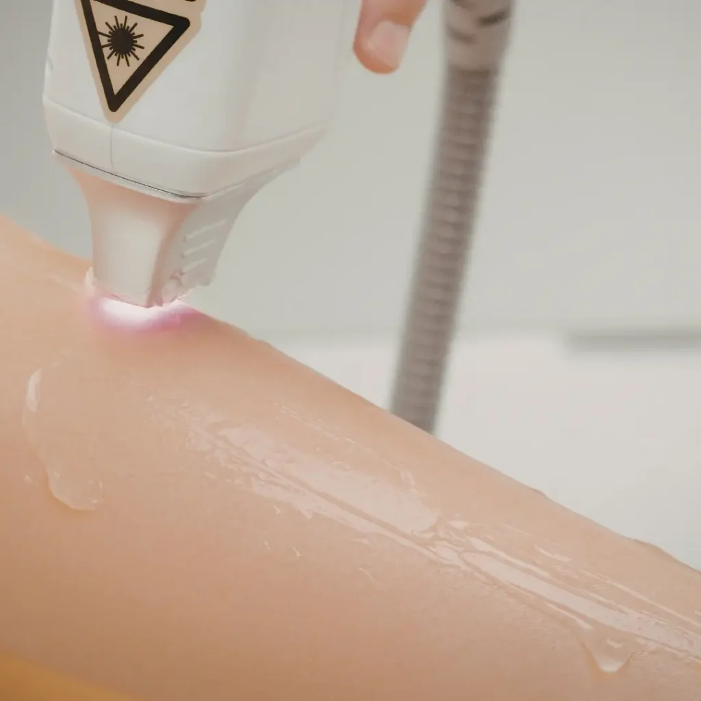 คู่มือเลเซอร์กำจัดขน