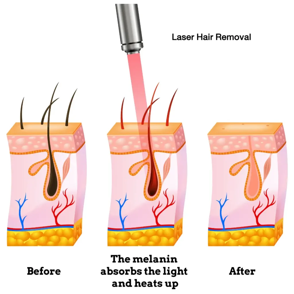 หลักการทำงานของ เลเซอร์กำจัดขน ที่รากขน