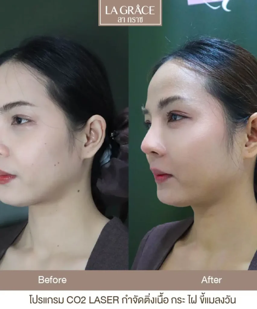 รีวิวกำจัดติ่งเนื้อด้วย CO2 Laser