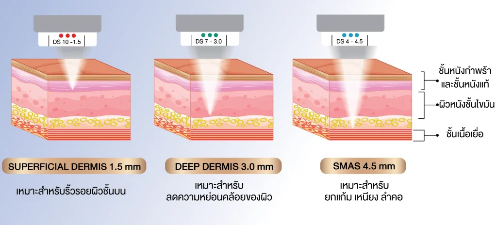 หัว 1.5 3.0 4.5 mm ต่างกันอย่างไร ในแต่ละชั้นผิว Dermis และ SMAS