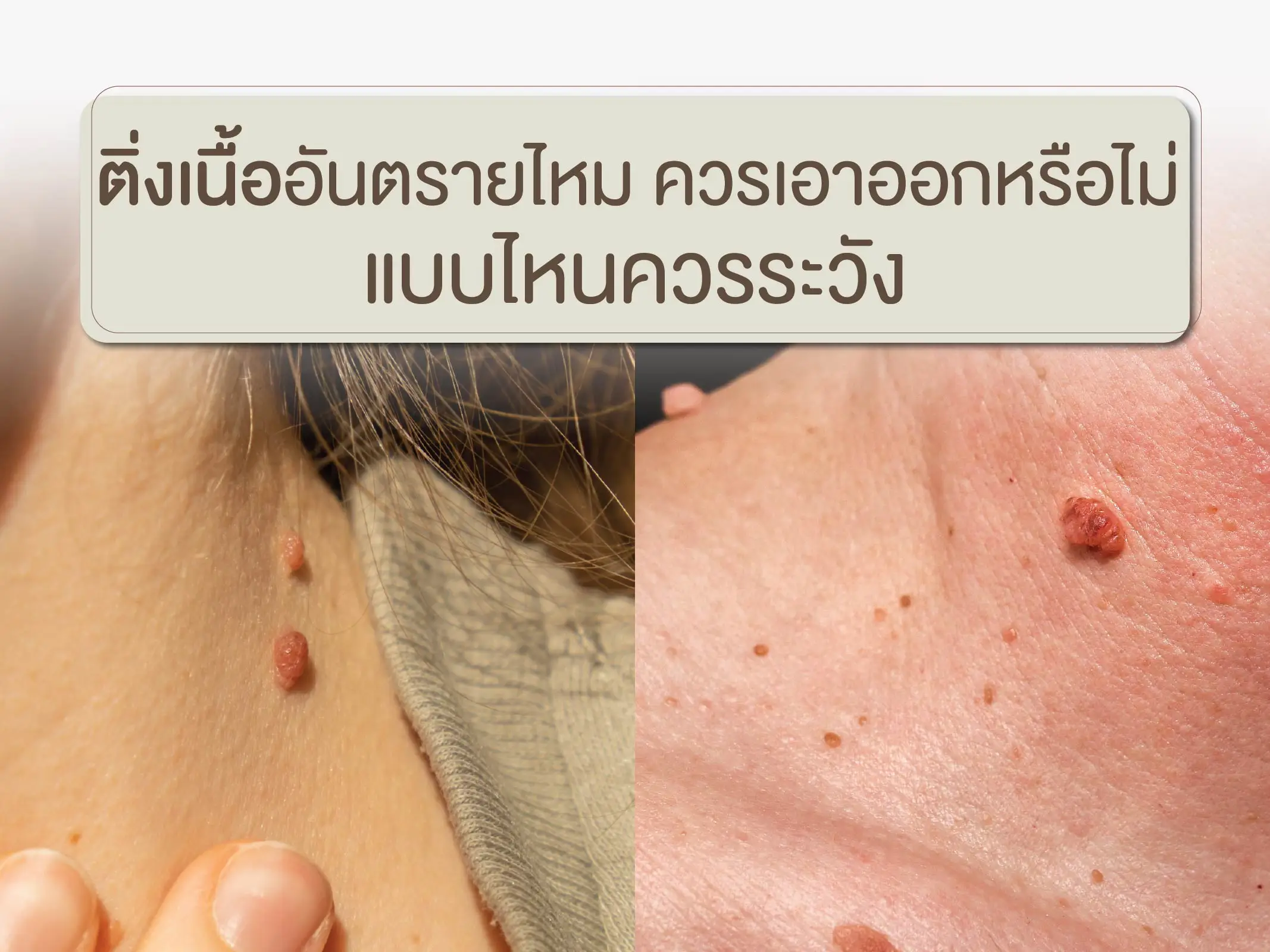 ติ่งเนื้ออันตรายไหม