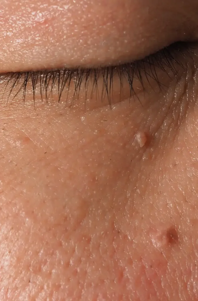 ติ่งเนื้อ 