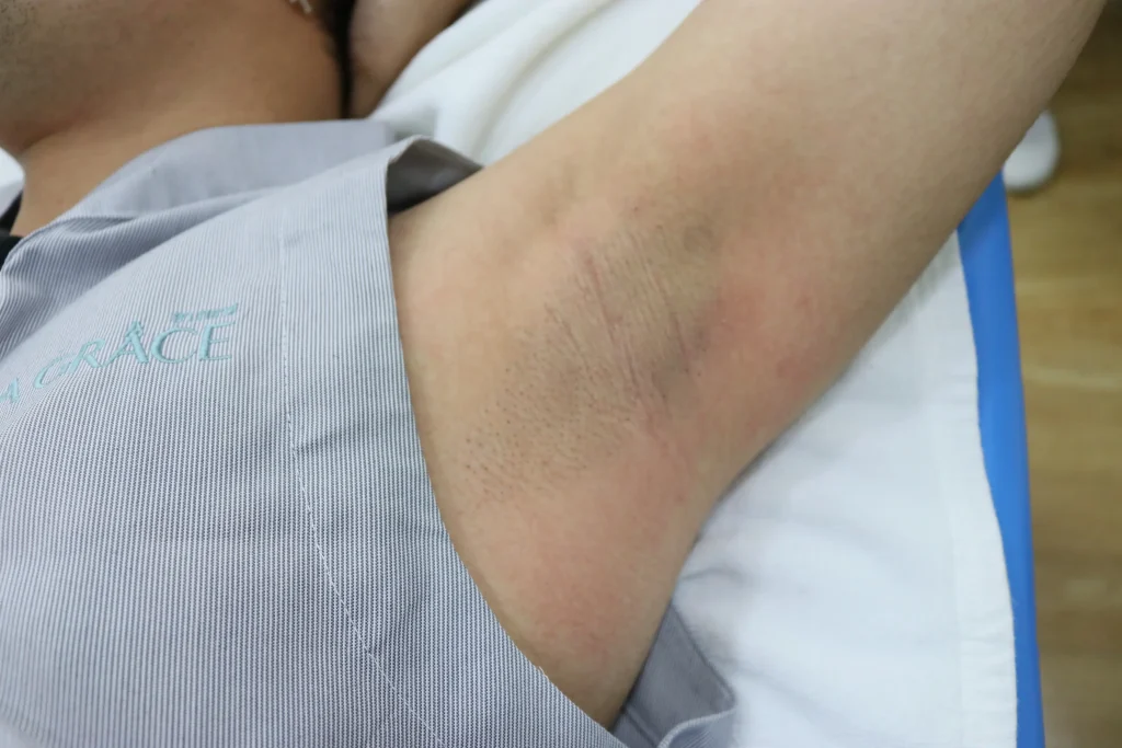 หลังทำ เลเซอร์กำจัดขน