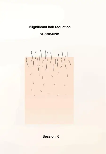 เลเซอร์กำจัดขน กี่ครั้งเห็นผล - ครั้งที่ 6