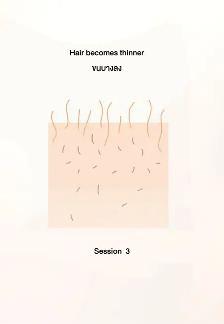 เลเซอร์กำจัดขน กี่ครั้งเห็นผล - ครั้งที่ 3