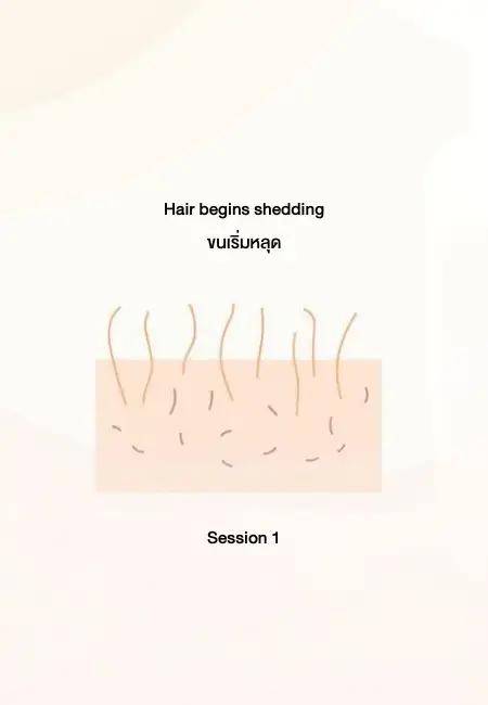 เลเซอร์กำจัดขน กี่ครั้งเห็นผล - ครั้งที่ 1