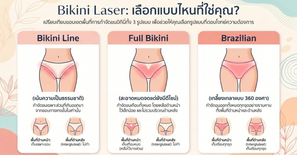 ความแตกต่างของเลเซอร์บิกินี่
