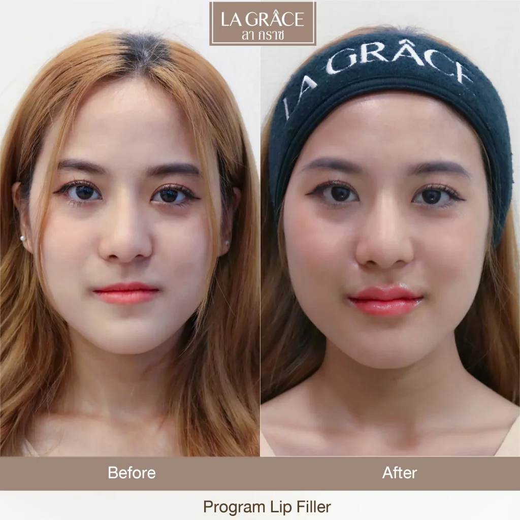 ฉีดฟิลเลอร์ปาก สีลม