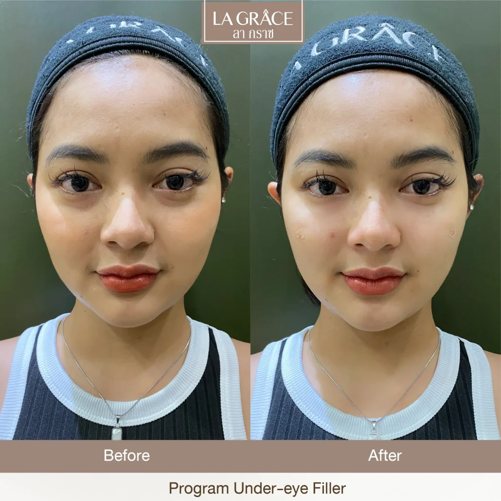 ฉีดฟิลเลอร์ใต้ตา สีลม