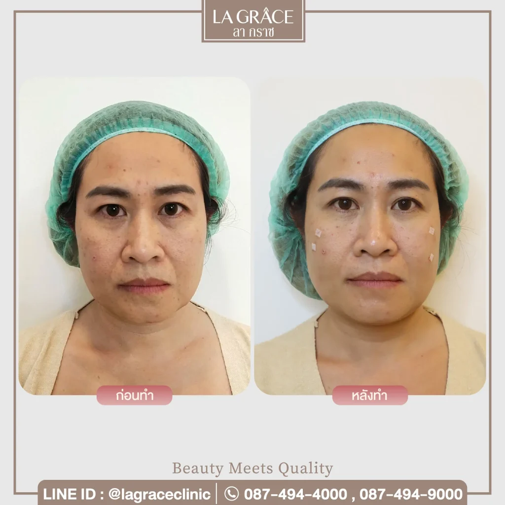 ผลลัพธ์ก่อนและหลังร้อยไหมช่วยยกกระชับใบหน้าให้เรียวขึ้น