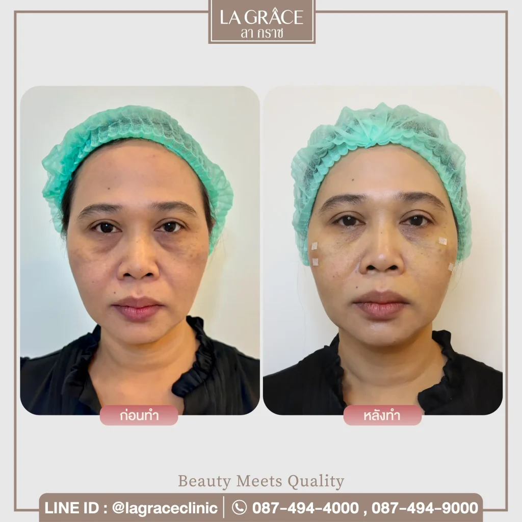 รีวิวร้อยไหมยกกระชับหน้าในผู้ที่มีปัญหาผิวหย่อนคล้อย