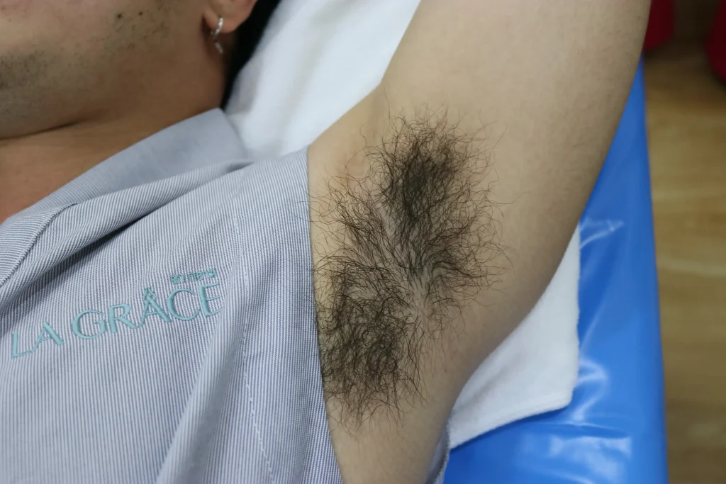 ก่อนทำเลเซอร์ขนรักแร้ มีขนหนาและตอขนชัด