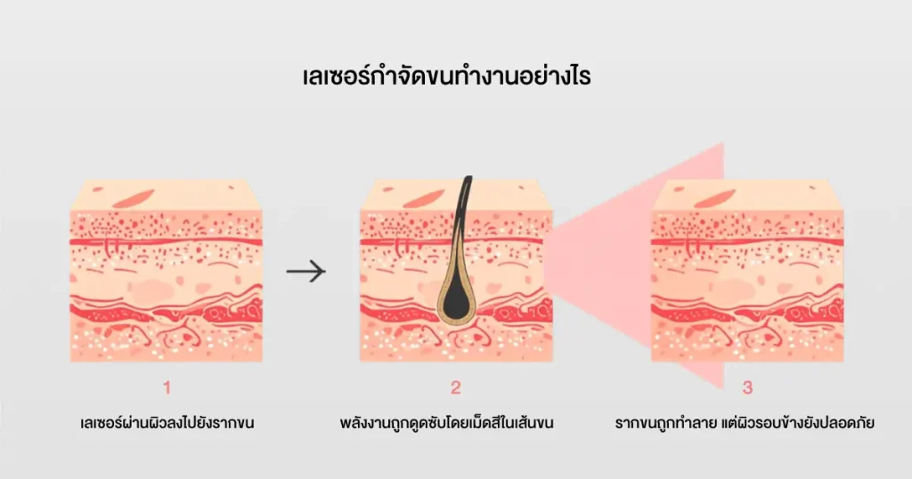 ภาพอธิบายกลไกเลเซอร์กำจัดขนที่จับเฉพาะรากขนและไม่กระทบผิวรอบข้าง