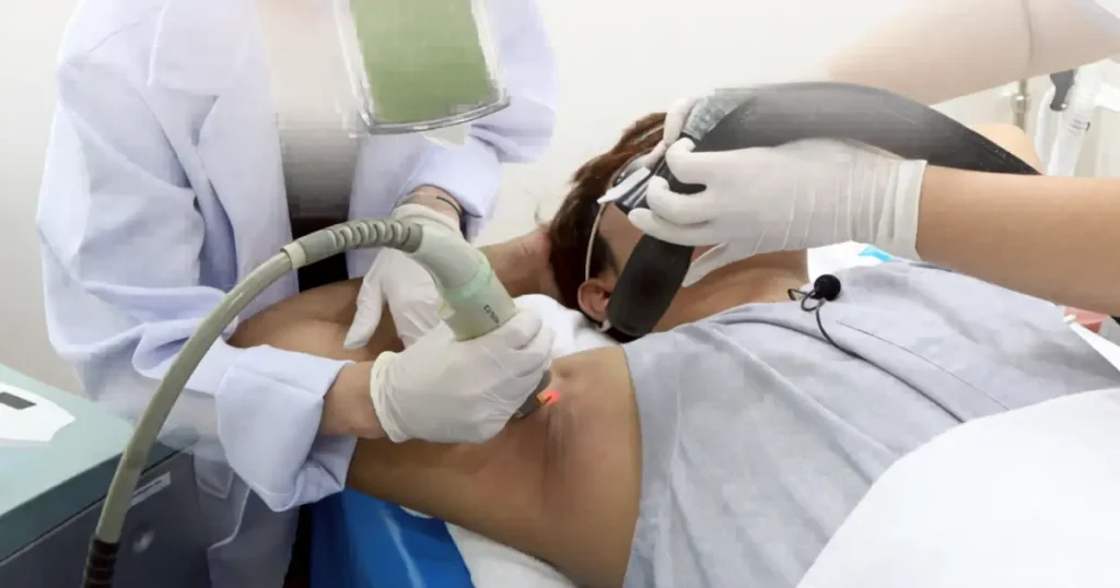 เลเซอร์ขนรักแร้เพื่อลดรักแร้คล้ำ หนังไก่ และขนคุด