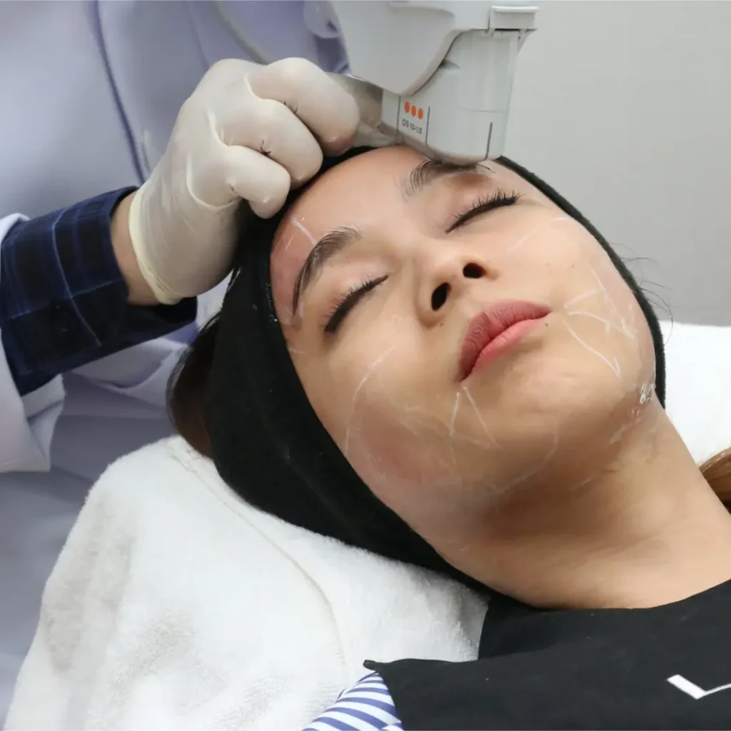 การยิง Ulthera 1.5 mm บริเวณหน้าผากและรอบดวงตา