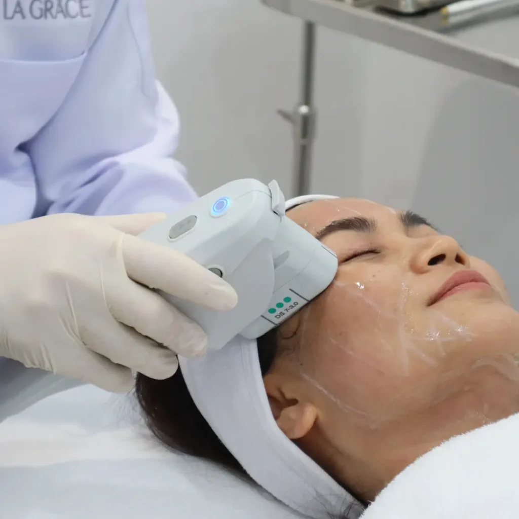 การยิง Ulthera 3.0 มม เพื่อกระชับผิวบริเวณแก้มและขมับ