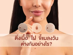 ติ่งเนื้อ ไฝ ขี้แมลงวัน ต่างกันอย่างไร