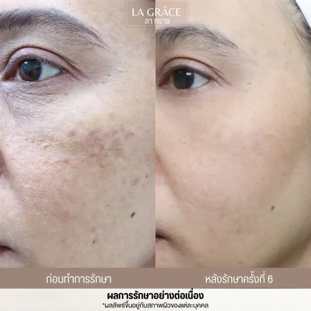 ก่อนหลังรักษาฝ้า ผลลัพธ์ melasma treatment หลังทำเลเซอร์และโปรแกรมลดเม็ดสี