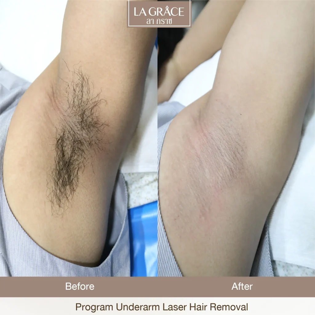 ผลลัพธ์เลเซอร์กำจัดขนรักแร้ที่ La Grace Clinic ก่อนและหลังทำ ขนลดลงชัดเจน