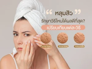 หลุมสิว รักษา