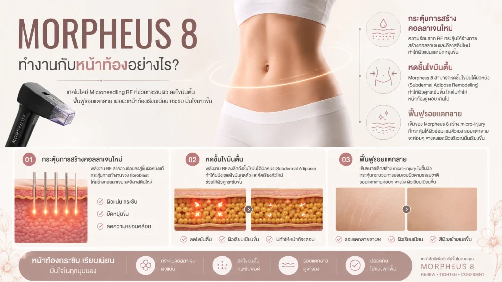 Morpheus 8 ทำงานกับหน้าท้องอย่างไร กระตุ้นคอลลาเจน หดไขมัน ฟื้นฟูรอยแตกลาย
