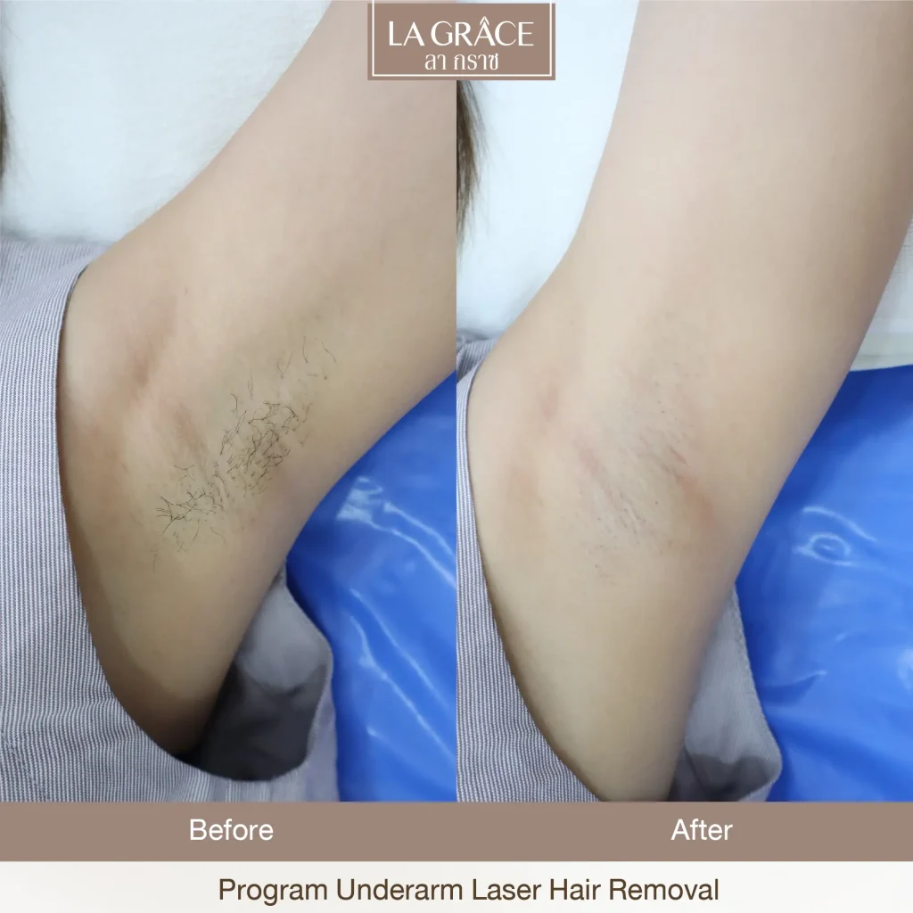Before and after underarm laser hair removal at La Grace Clinic Bangkok
