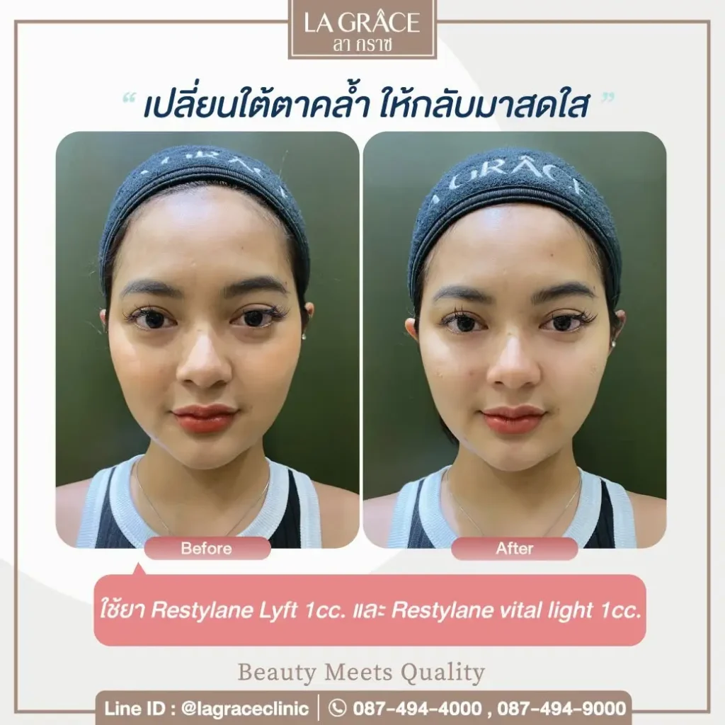 Before and after under eye filler treatment showing reduced tear trough shadowing